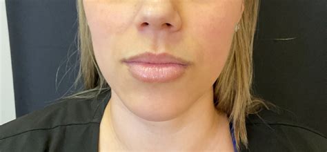 Lip Fillers Before And After Dr Quinn