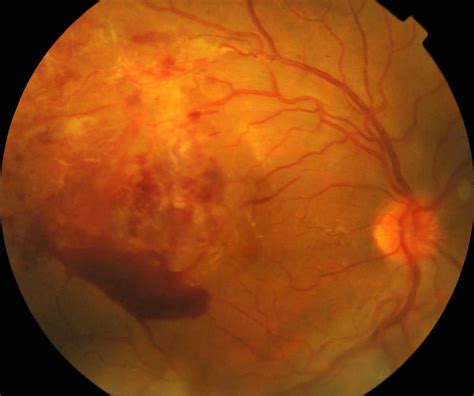 Retinal Vasculitis Causes Symptoms Diagnosis Treatment Prognosis