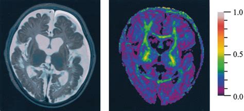 Follow Up Mr Imaging At Age Months When The Patient Had Severe