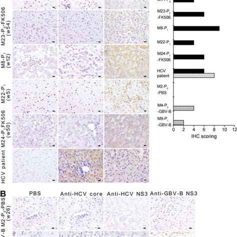 Immunohistochemical Staining Of Hcv Ns Protein In Liver Tissues Of