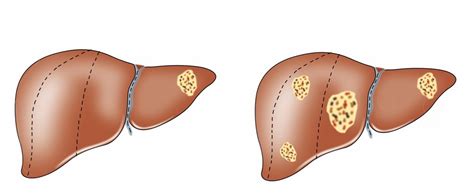 Liver Cancer & Metastases Treatment - Liver Specialist & Surgeon Perth