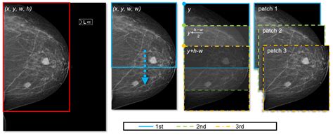 Two Stage Deep Learning Method For Breast Cancer Detection Using High