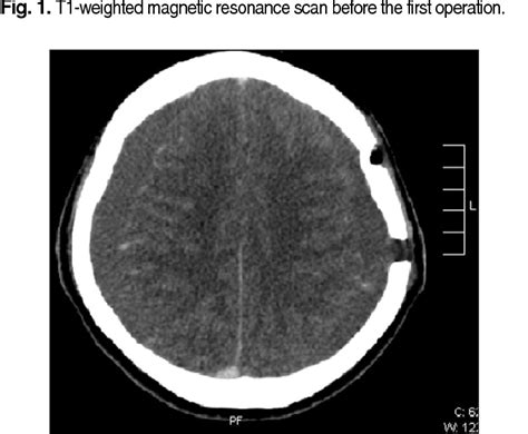 Cranial Computed Tomography Scan With Contrast Reveals Bilateral