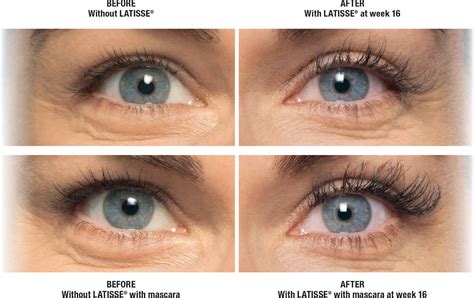 5 ml Latisse® Online Prescription Canada | Eyelash Serum | Certified ...
