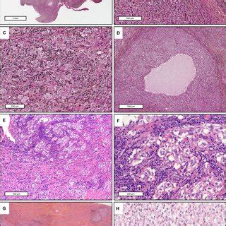 Histopathological Features Case 1 Hematoxylin Eosin Saffron HES A