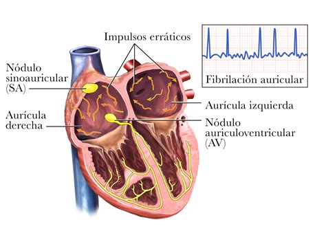 Fibrilación auricular Causas y factores de riesgo NHLBI NIH