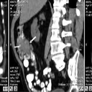 MSCT Tumor Of The Cecum With Metastases In The Abdominal Cavity