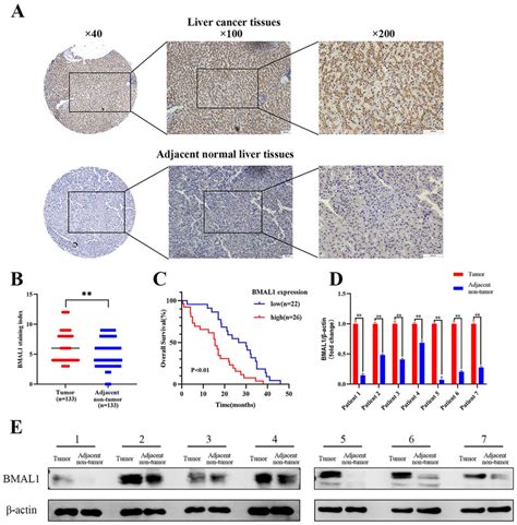 Bmal Expression Is Increased In Hcc Tissues And Is Associated With