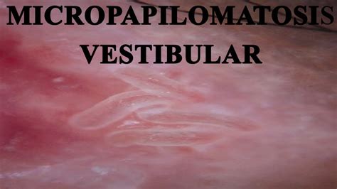 Papilomatosis Vestibular Una Confusi N Con Vph Youtube