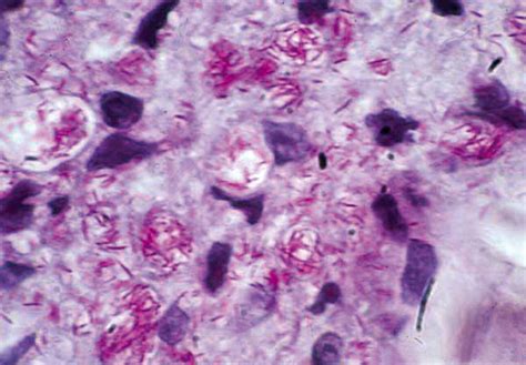 Mycobacterium Leprae Acid Fast