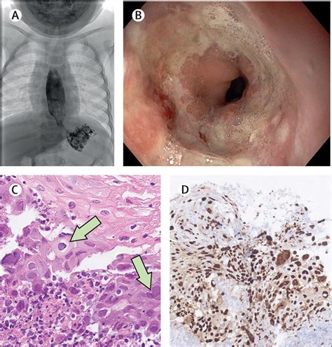 Herpes Esophagitis