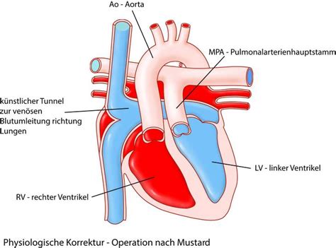 Transposition der großen Gefäße UKM Klinik für Herz und Thoraxchirurgie