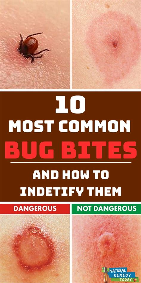 Discover How To Identify The 8 Most Common Insect Bites Insect Bites Nbkomputer