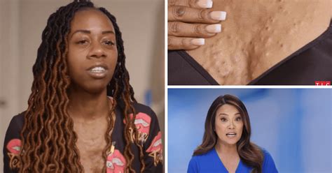 Where Is Brittney Now Dr Pimple Popper Patient Embraces Her Beauty