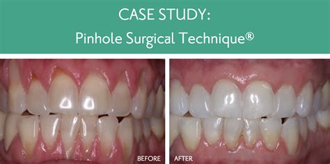 How Effective Is Pinhole Gum Surgery - A Pictures Of Hole 2018