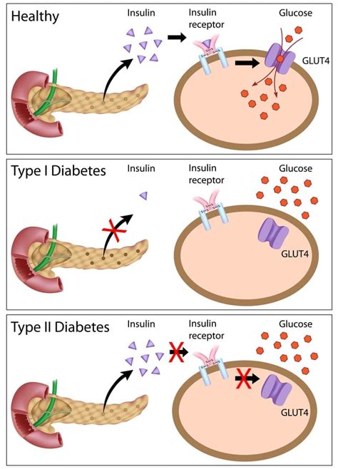 Insulin Resistance And The Ketogenic Diet Keto Science