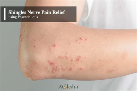 10 best essential oils for shingles nerve pain relief – Artofit