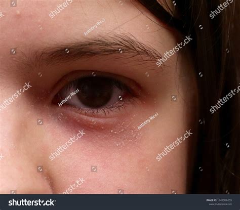 Eyelid Atopic Dermatitis Eczema Scaling Red Foto Stock 1541906255 Shutterstock