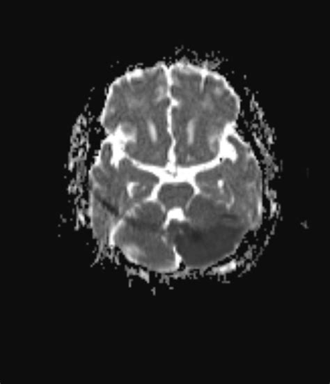 Left Posterior Inferior Cerebellar Artery Pica Infarct Image