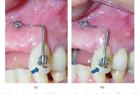 Figure 11 From Dental Extrusion With Orthodontic Miniscrew Anchorage A Case Report Describing A