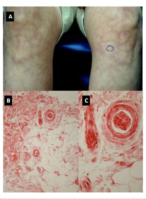 Case A Livedo Racemosa Characterized By Mottled Erythematous To