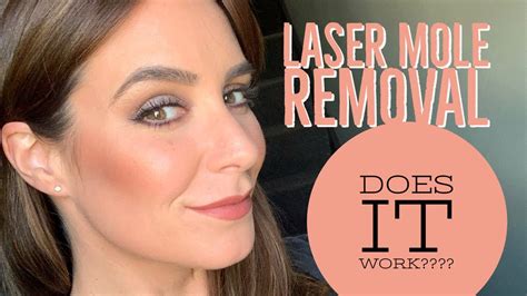 Laser Mole Removal My Experience Is It Worth It Does It Work