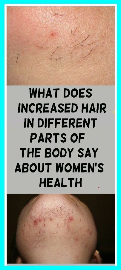 What Does Increased Hair In Different Parts Of The Body Say About Women