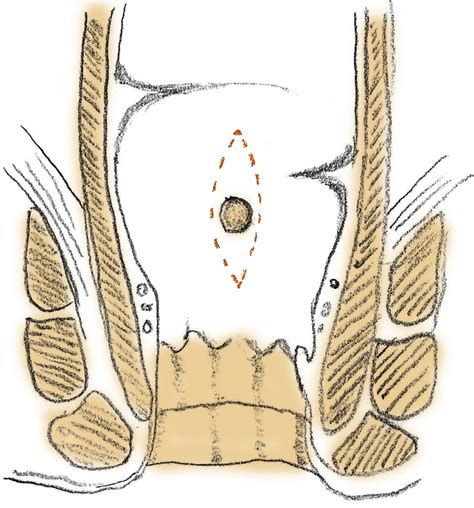 Minimally Invasive Transanal Repair Of Rectourethral Fistulas