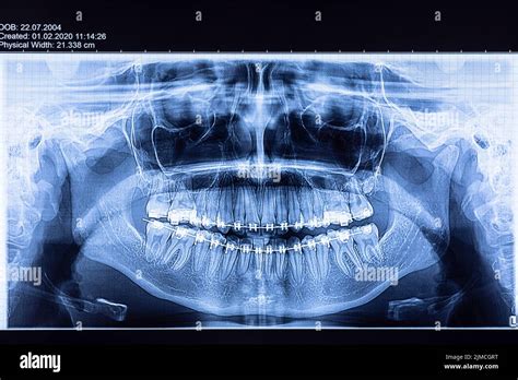 Radiografia Panoramica Immagini E Fotografie Stock Ad Alta Risoluzione