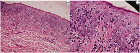 Histopathology Of Skin Biopsy Showing Epidermal Mild Hyperplasia And