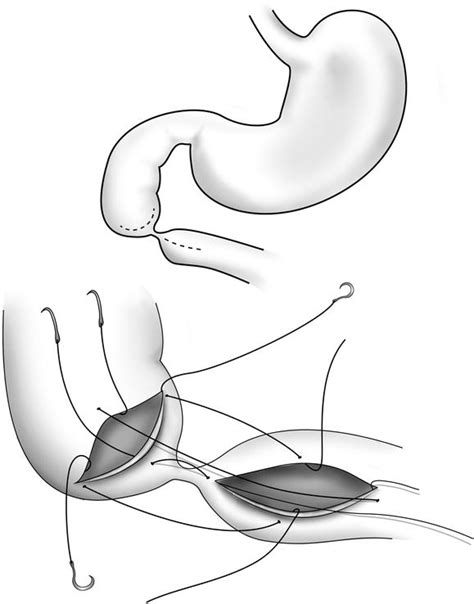 Congenital Duodenal Obstruction Atresia Stenosis And Annular