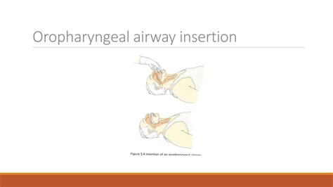 PPT - Basic Airway PowerPoint Presentation, free download - ID:6401014