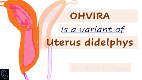 Ohvira Is A Variant Of Uterus Didelphys Youtube