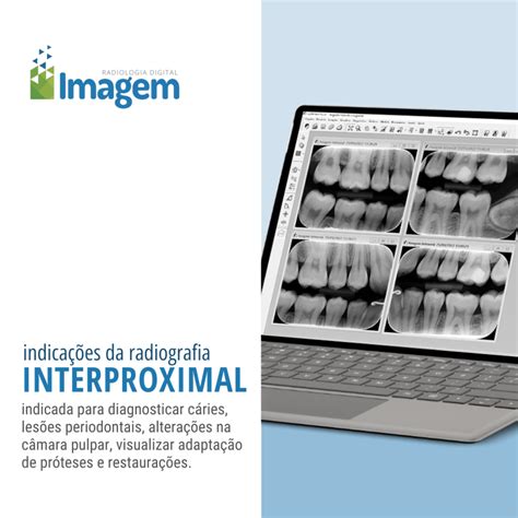 Indica Es Da Radiografia Interproximal Imagem Radiologia