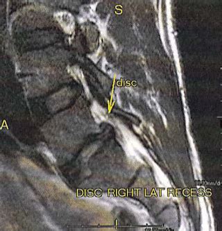 Herniated Lumbar Disc L S