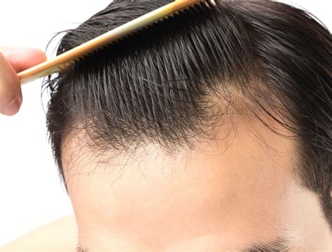 How To Thicken Your Hairline Tips Tricks And Hair Care Best Simple Hairstyles For Every Occasion