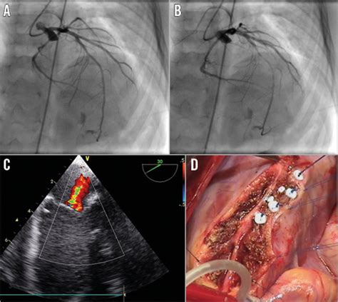 Myocardial Bridge