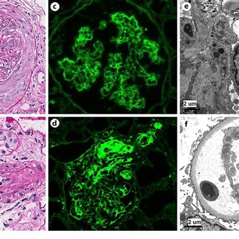 Renal Biopsy Findings A B Light Microscopy Images Demonstrating