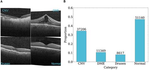 Frontiers GABNet Global Attention Block For Retinal OCT Disease