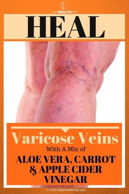 Heal Your Varicose Veins With A Mix Of Aloe Vera Carrot And Apple