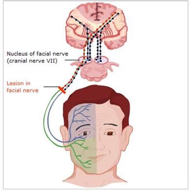 Acute Facial Palsy Rcemlearning