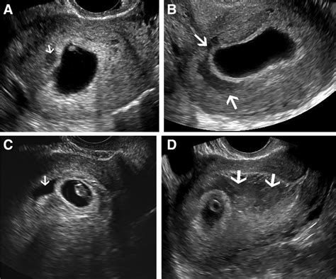 Subchorionic Hematoma Correlation Of Grading Techniques With First