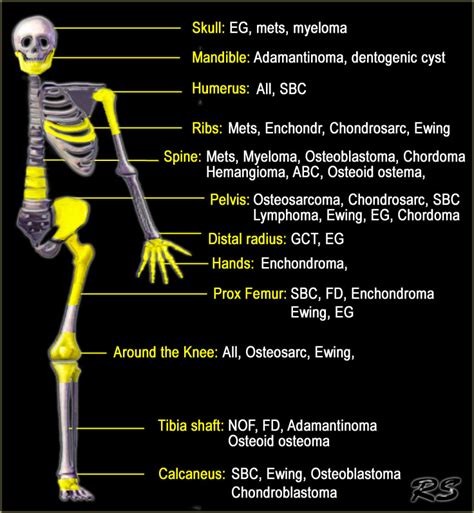 The Radiology Assistant : Bone tumors - Differential diagnosis