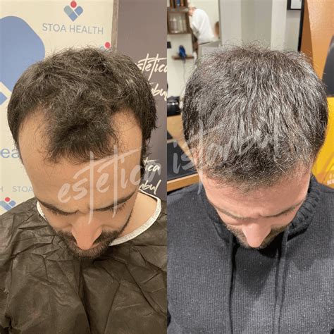 Hair Transplant Turkey Before After Estetica Istanbul