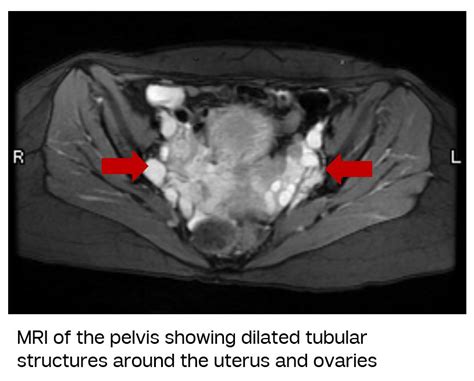 Pelvic Venous Disorder (previously called Pelvic Congestion) | Vein ...