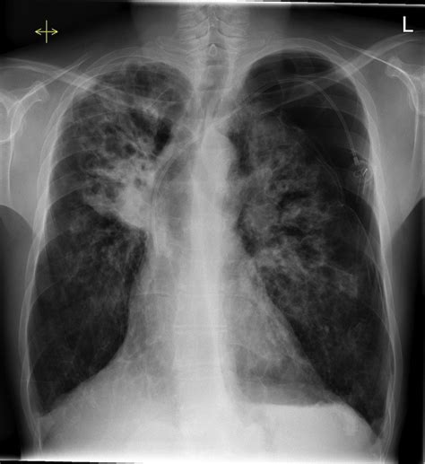 Pneumothorax Complications Ppt Chest Trauma Chest Tubes