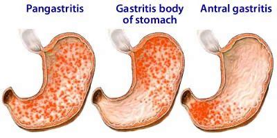 Gastritis Treatment Services in Chandigarh | ID: 7029383991