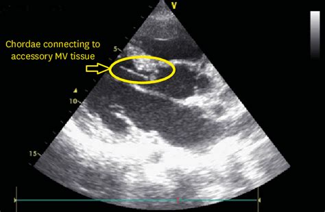 Parasternal Long Axis View Showing Accessory Mitral Valve Tissue