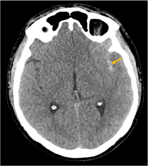 Plain Head CT Demonstrating Subarachnoid Hemorrhage At Left Sylvain