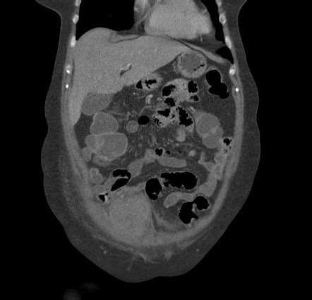 Rectus Sheath Hematoma Image Radiopaedia Org